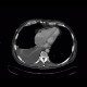 Pericardial calcification, calcified pericarditis, pericarditis calcarea: CT - Computed tomography